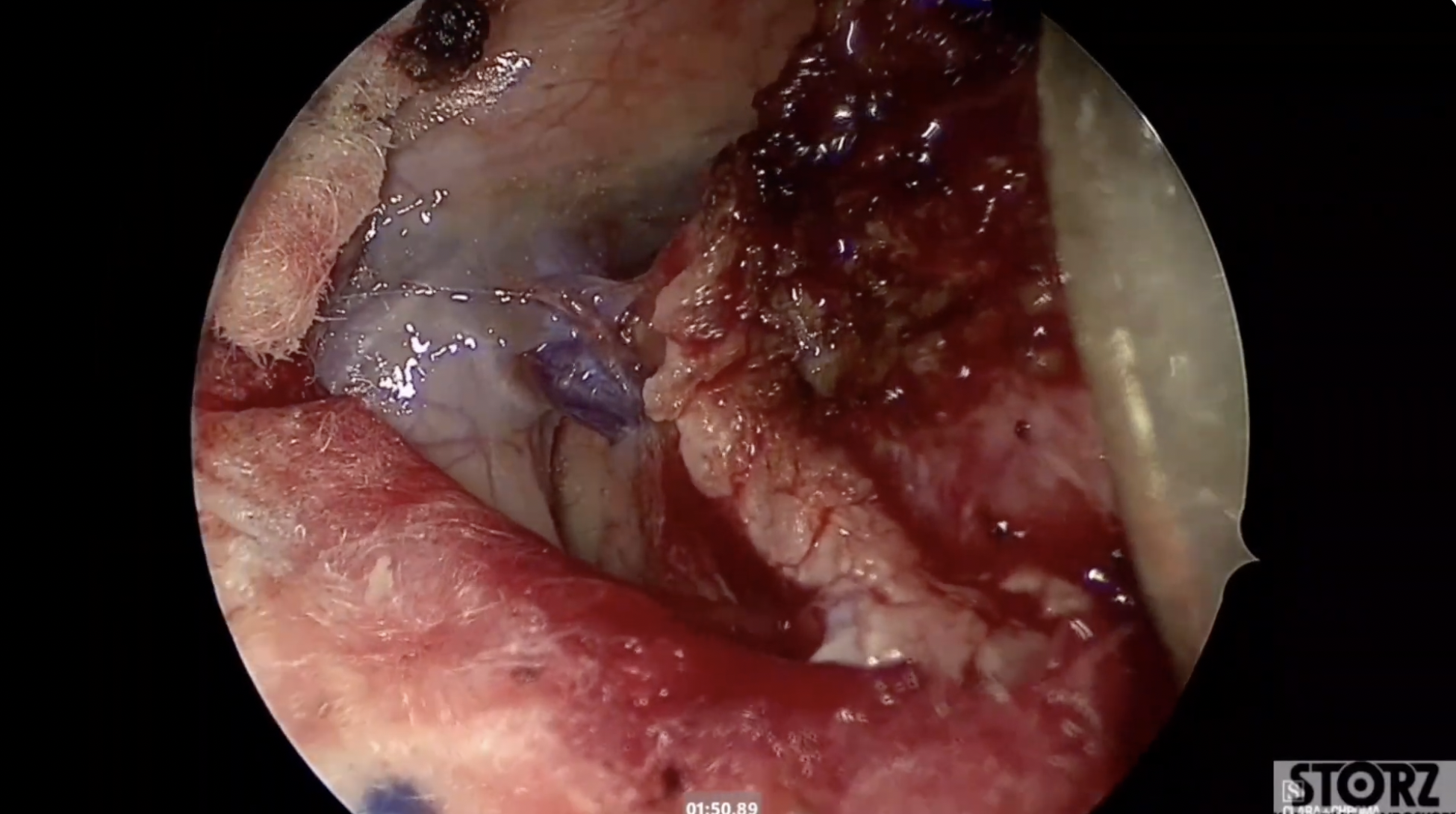 Medial Sphenoid Wing Meningioma- Endoscopic Transorbital Resection