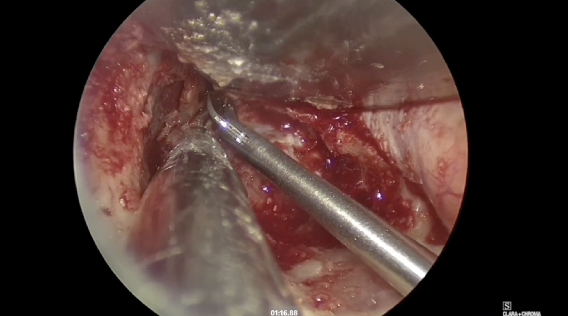 Lateral Sphenoid Encephalocele  Repair- Endoscopic Transorbital Approach case no 1
