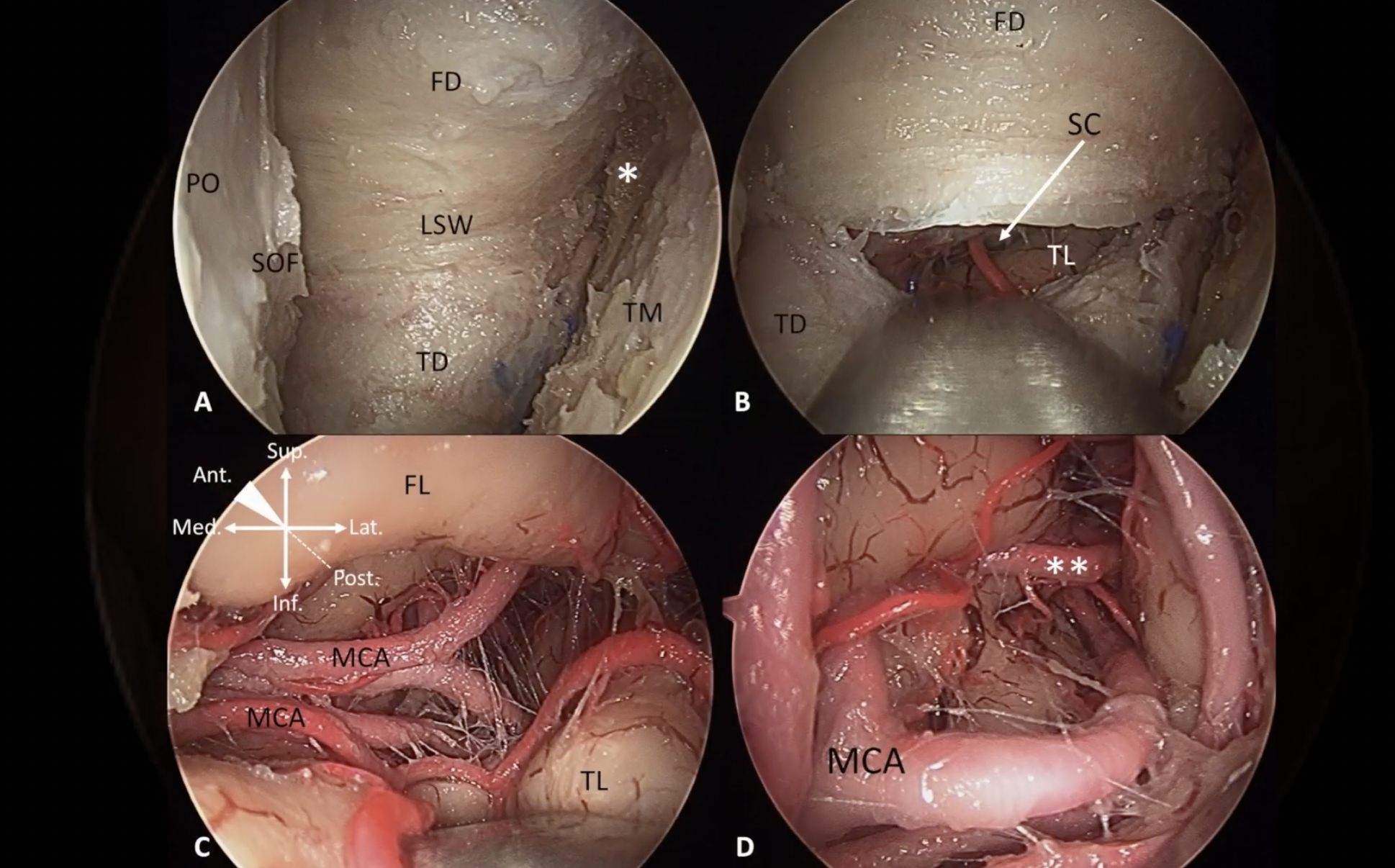 Transorbital Anatomy 